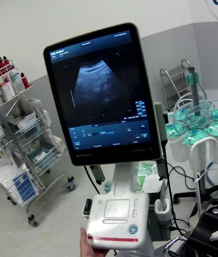 Echographie per-opératoire