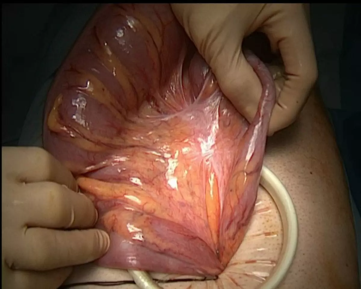 Volvulus du sigmoide