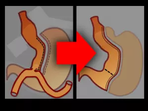 Conversion en "Sleeve gastrectomie"