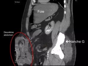 Eventration abdominale majeure