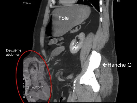 Cure D’Éventration Abdominale – Cure D’Éventration C’Est Quoi – OJTI