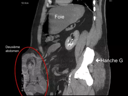 Eventration abdominale majeure