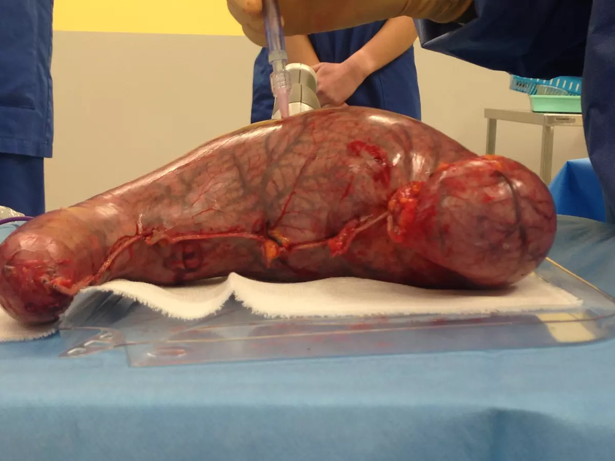 La sonde "gastric sail" ou voile gastrique