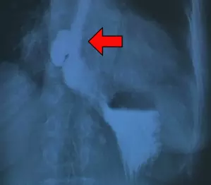 Diverticule de l'oesophage