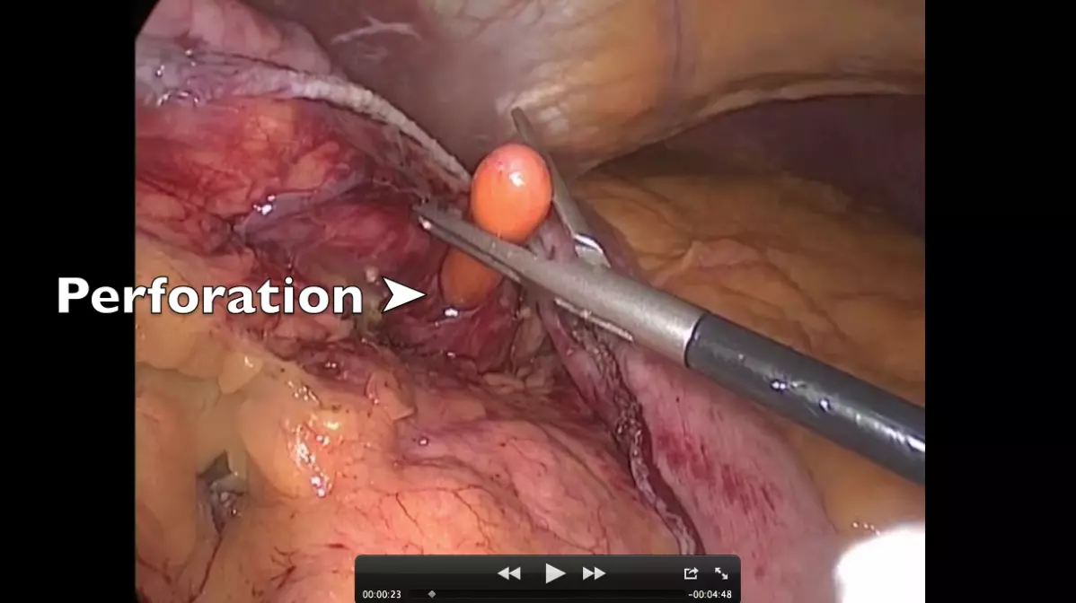 Perforation par sonde