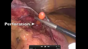 Perforation par sonde