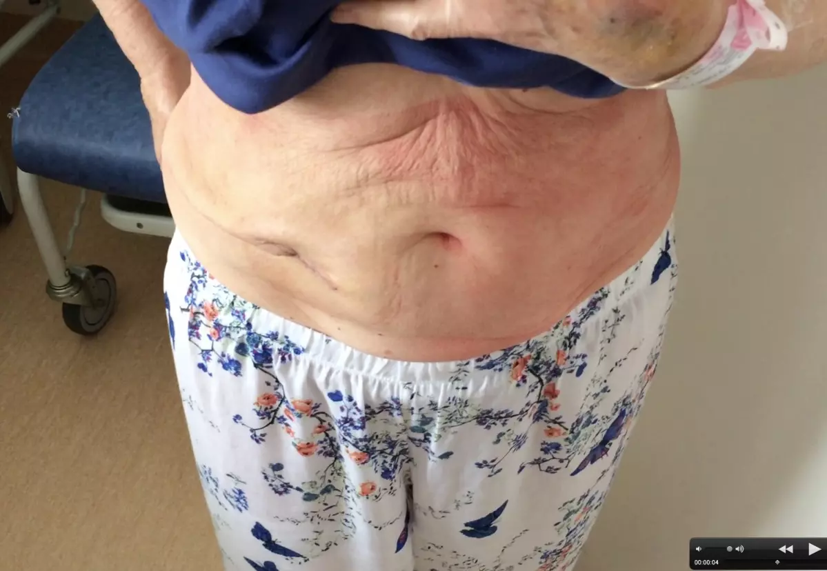 Chirurgie colique "single port"