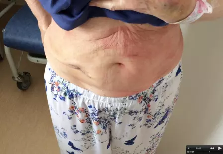 Chirurgie colique "single port"