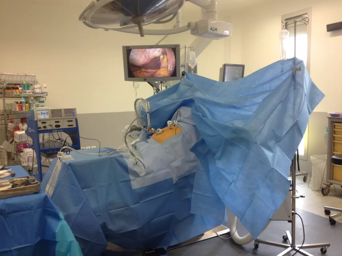 Cholecystectomie chez le super-obèse