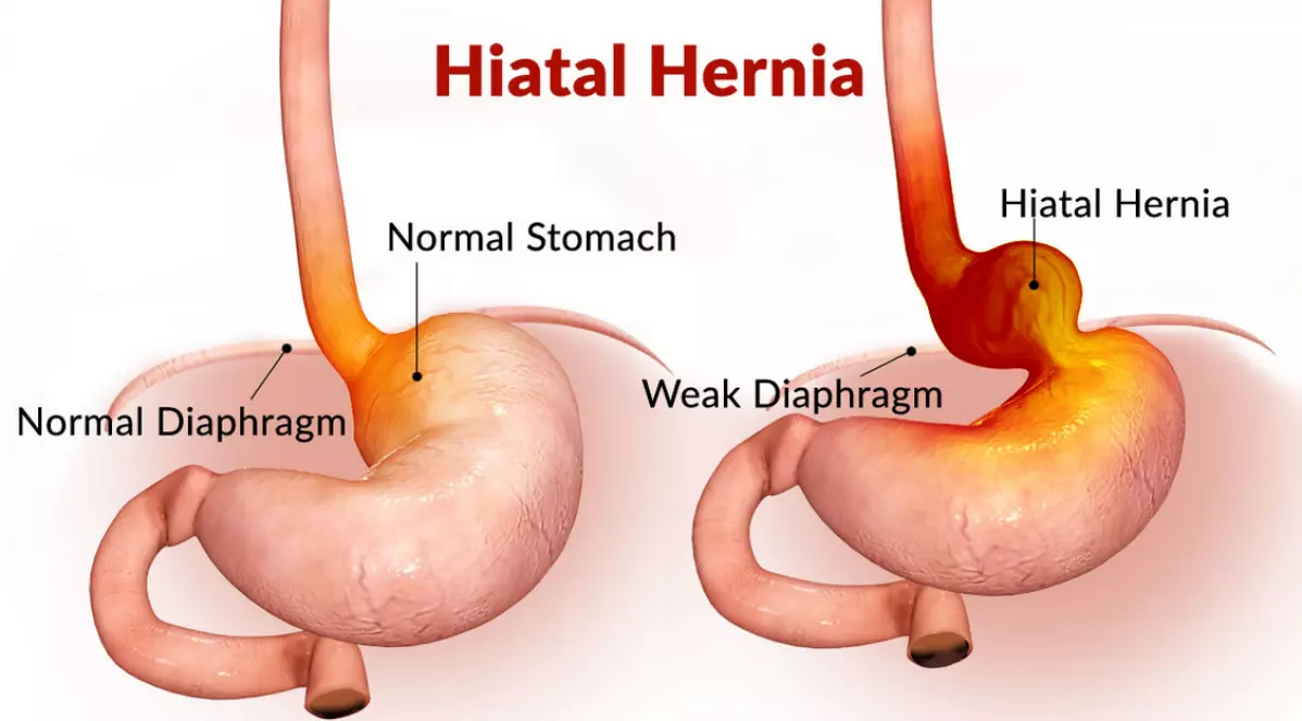 Hernie hiatale de gauche à droite