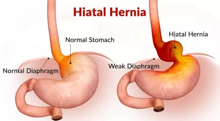 Hernie hiatale de gauche à droite