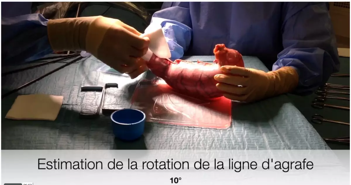 Trucs et astuces en chirurgie de l'obésité