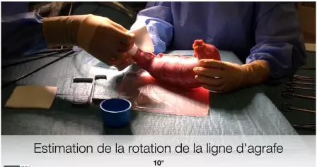 Trucs et astuces en chirurgie de l'obésité