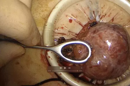 Chirurgie coelioscopique monotrocart