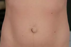 hernie ombilicale