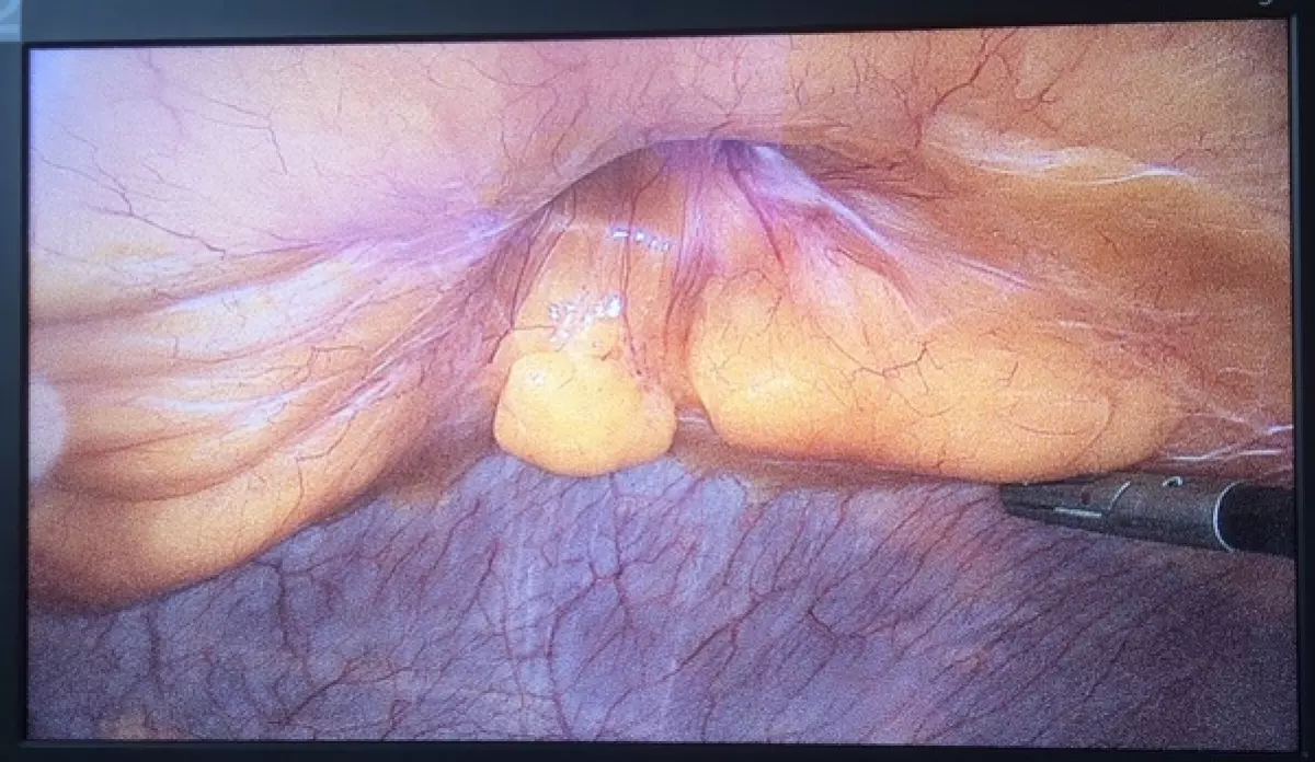 Cure de hernie ombilicale par coelioscopie