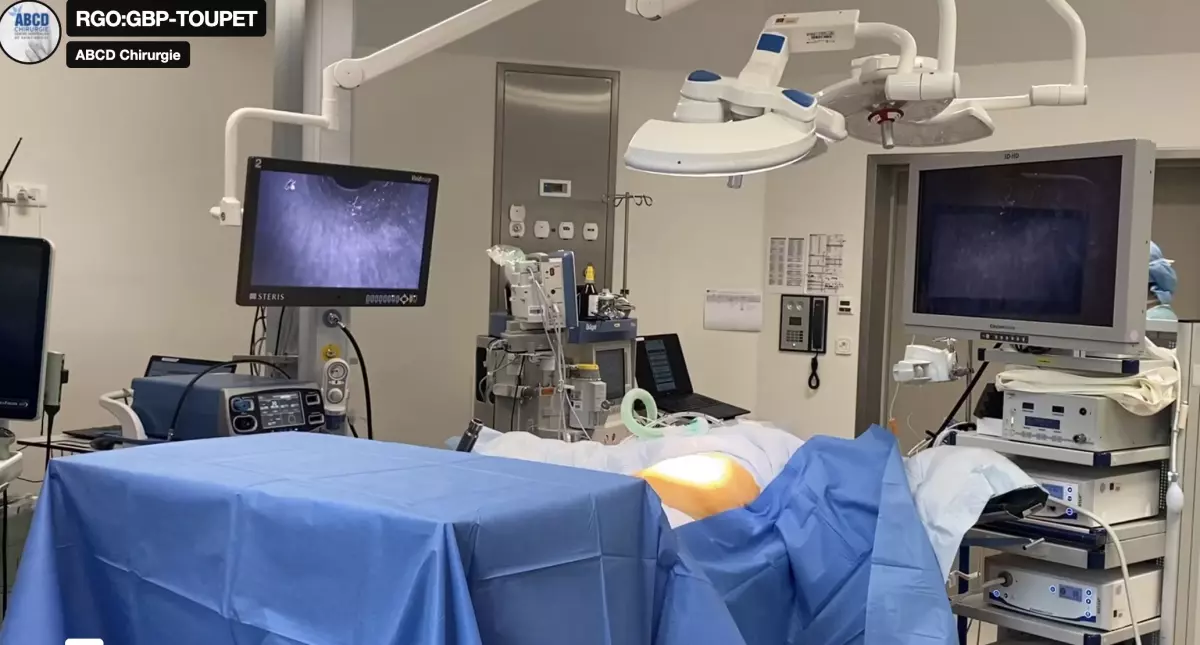 Reflux post BYPASS. Hémi-valve postérieure (TOUPET)